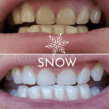 Load image into Gallery viewer, SNOW Teeth Whitening + Lip Balm Bundle