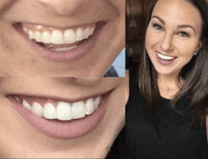GRONK's Snow® Teeth Whitening At-Home System [All-in-One Kit]