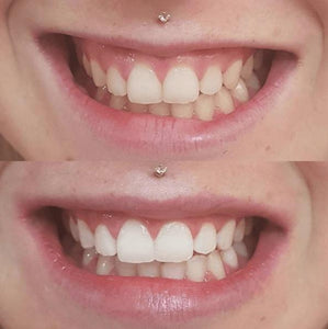 SNOW TEETH WHITENING™ – SYSTEM DO WYBIELANIA ZĘBÓW W DOMU [ZESTAW WSZYSTKO W JEDNYM]