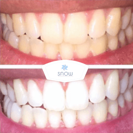 SNOW TEETH WHITENING™ SYSTÈME À DOMICILE [KIT TOUT-EN-UN]