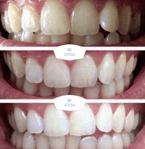 SNOW TEETH WHITENING™ – SYSTEM DO WYBIELANIA ZĘBÓW W DOMU [ZESTAW WSZYSTKO W JEDNYM]