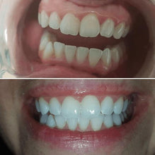Load image into Gallery viewer, SISTEMA EM CASA SNOW TEETH WHITENING™ [‘KIT’ COMPLETO]
