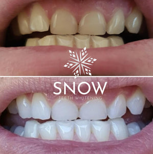 Dual-light, WIRELESS, Self-Sanitizing Snow® Smart Teeth Whitening At-Home System