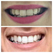 Load image into Gallery viewer, Snow® At-Home Teeth Whitening (ALL-IN-ONE KIT)
