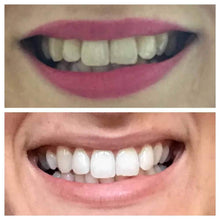 Load image into Gallery viewer, SNOW® SENSITIVE TEETH WHITENING AT-HOME SYSTEM [ALL-IN-ONE KIT]
