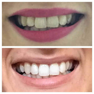 Snow® At-Home Teeth Whitening Kit